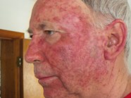 Mild Actinic Keratosis